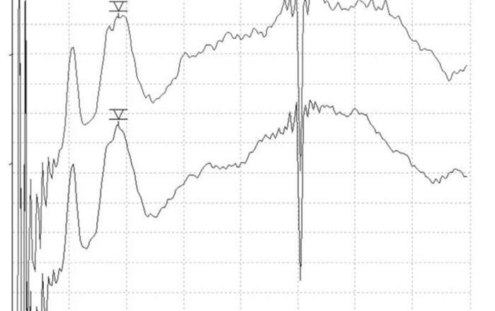 Grafik zeigt den Kurvenverlauf einer Messung elektrisch evozierter Hirnstammpotentiale