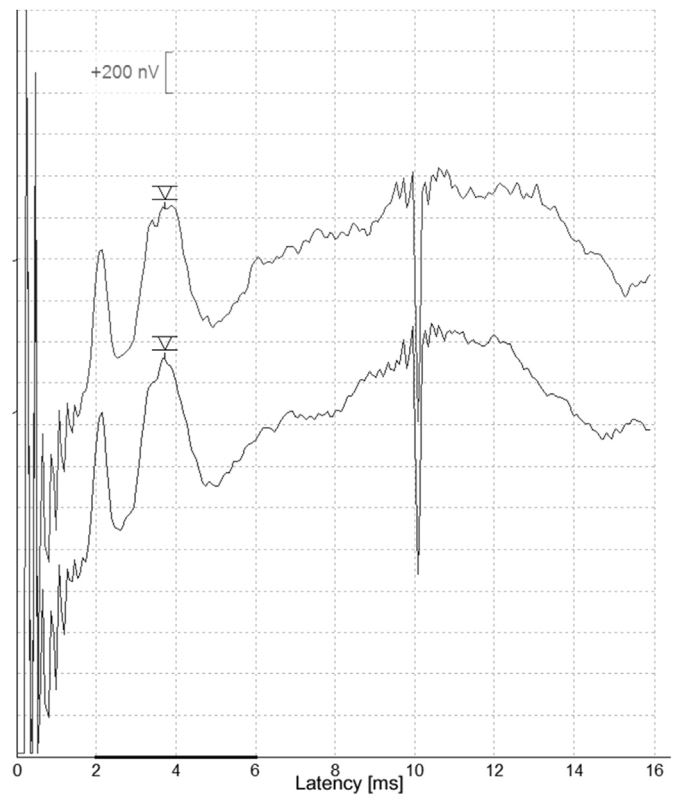 Grafik zeigt den Kurvenverlauf einer Messung elektrisch evozierter Hirnstammpotentiale